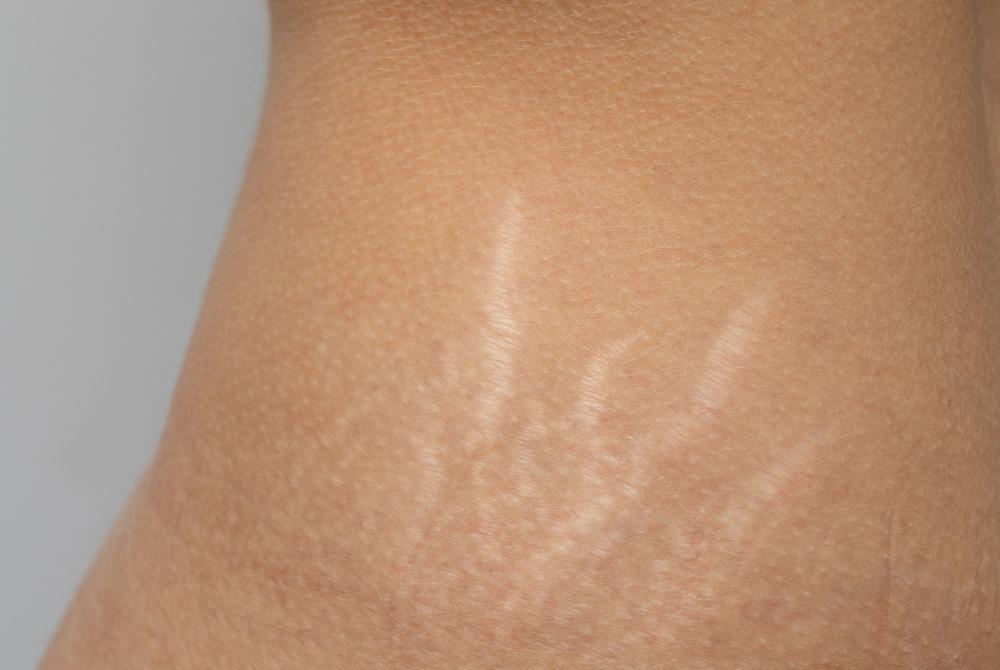 Sposoby na zmniejszenie widoczności rozstępów na brzuchu i udach po porodzie